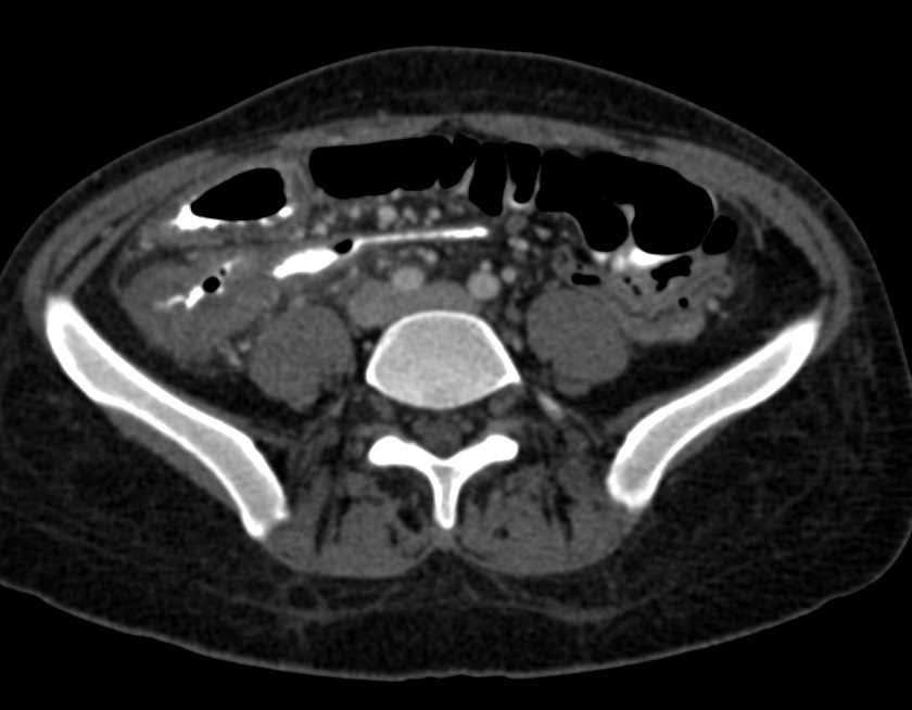 Crohn's Disease Involves Right Colon Especially Cecum and Terminal Ileum - CTisus CT Scan