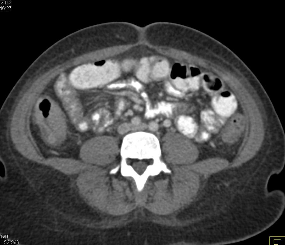 Pseudomembranous Colitis with Ascites - CTisus CT Scan