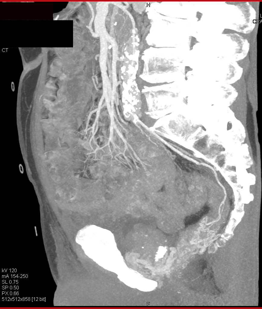 Gastrointestinal (GI) Bleed due to Prominent Rectal Varices - CTisus CT Scan