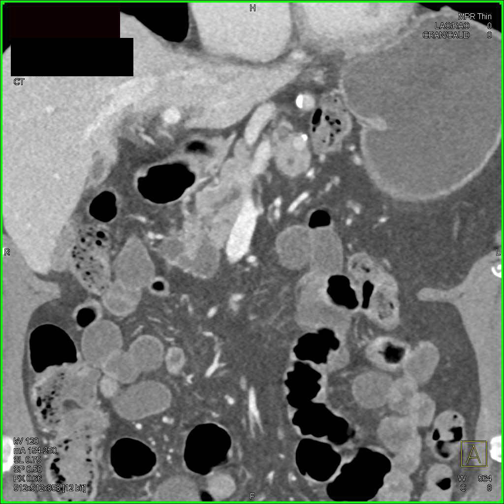 Gastrointestinal (GI) Bleed due to Prominent Rectal Varices - CTisus CT Scan