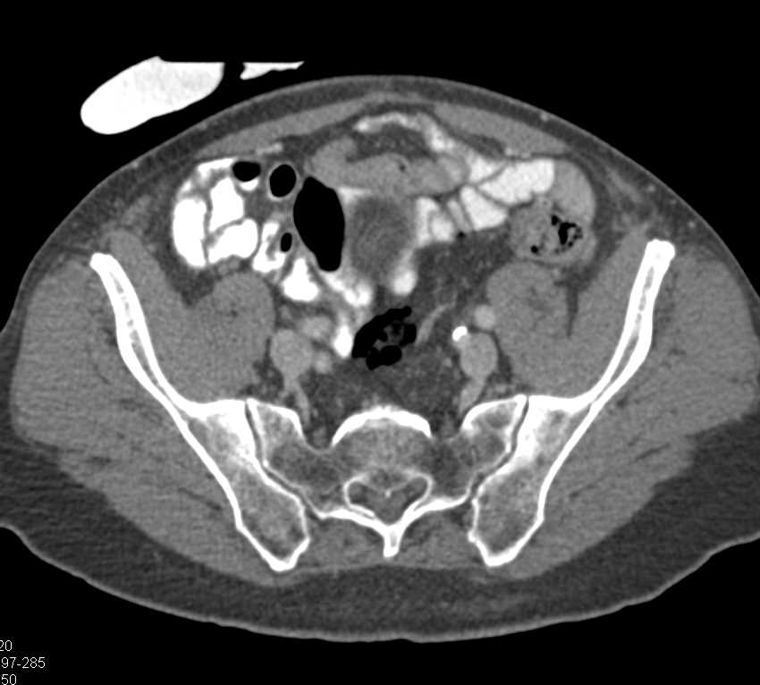 Perforated Rectum with Extensive Air Around the Rectum - CTisus CT Scan