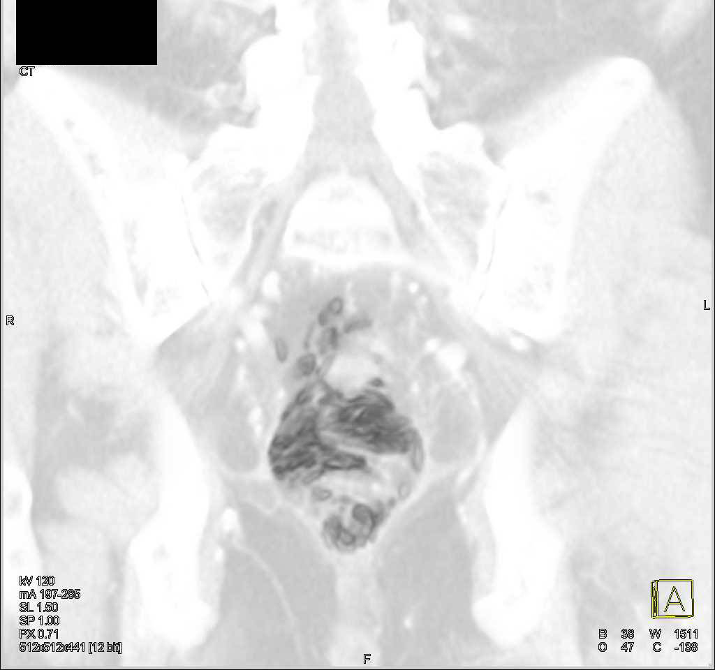 Perforated Rectum with Extensive Air Around the Rectum - CTisus CT Scan