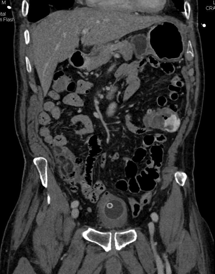 Active Gastrointestinal (GI) Bleed in Descending Colon due to Diverticulitis - CTisus CT Scan