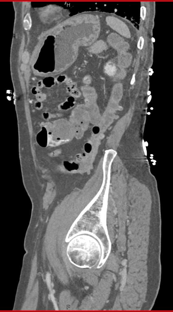 Active Gastrointestinal (GI) Bleed in Descending Colon due to Diverticulitis - CTisus CT Scan