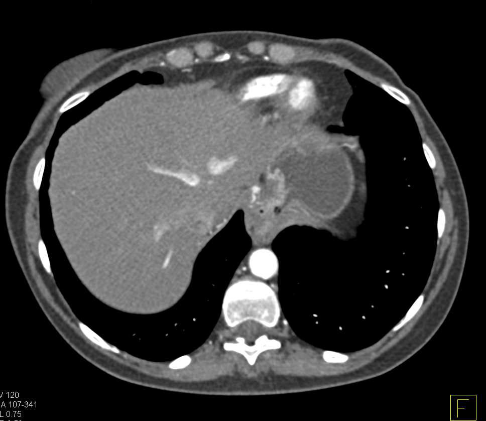 Crohn's Disease Involves Right Colon Especially Cecum with Comb Sign - CTisus CT Scan