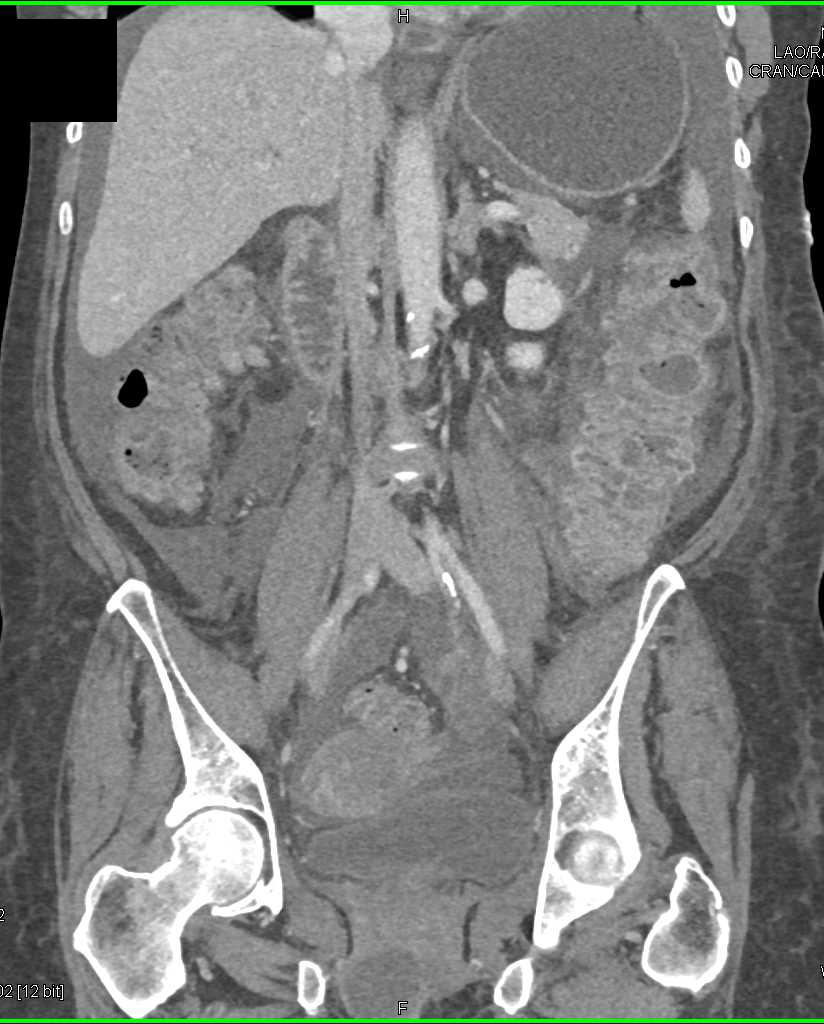 Pseudomembranous Colitis with Ascites - CTisus CT Scan