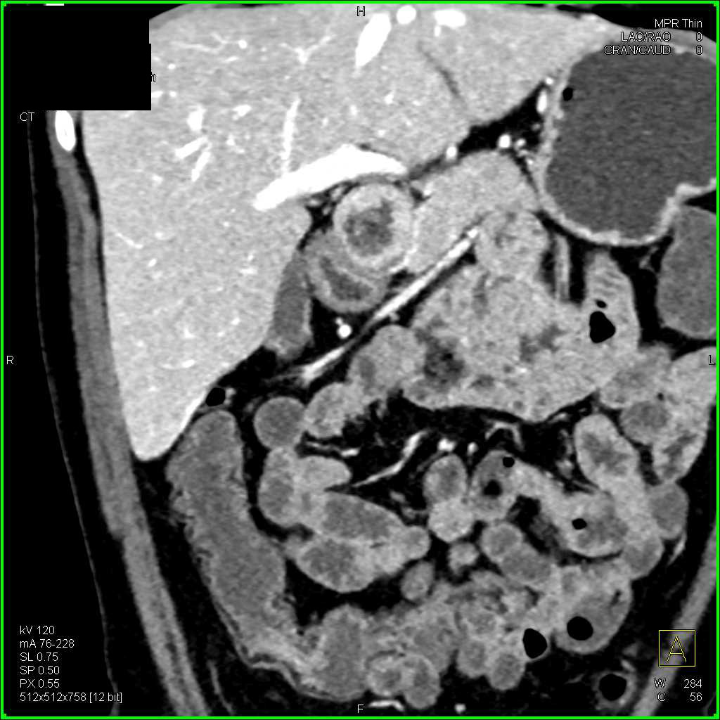 Crohn's Disease Colon and Terminal Ileum - CTisus CT Scan