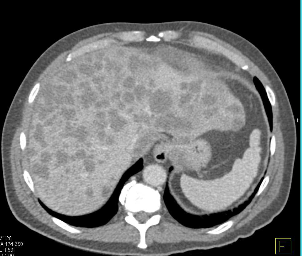 Carcinoma of the Sigmoid Colon with Liver Metastases - CTisus CT Scan