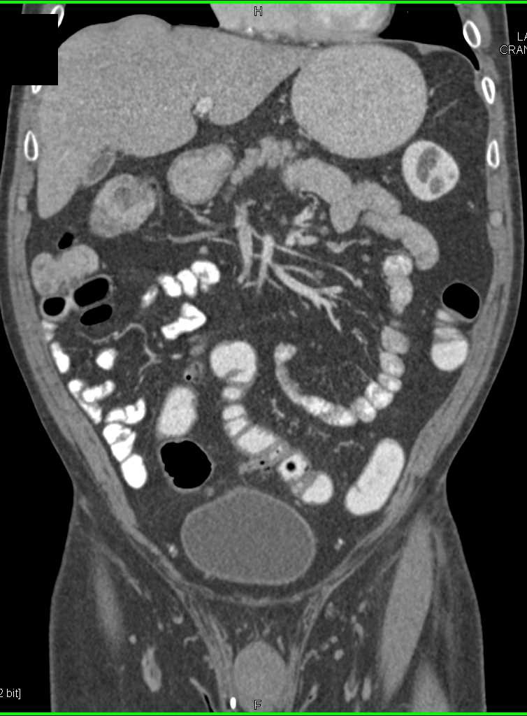 Diverticulitis with Sigmoid Colon Stricture - CTisus CT Scan