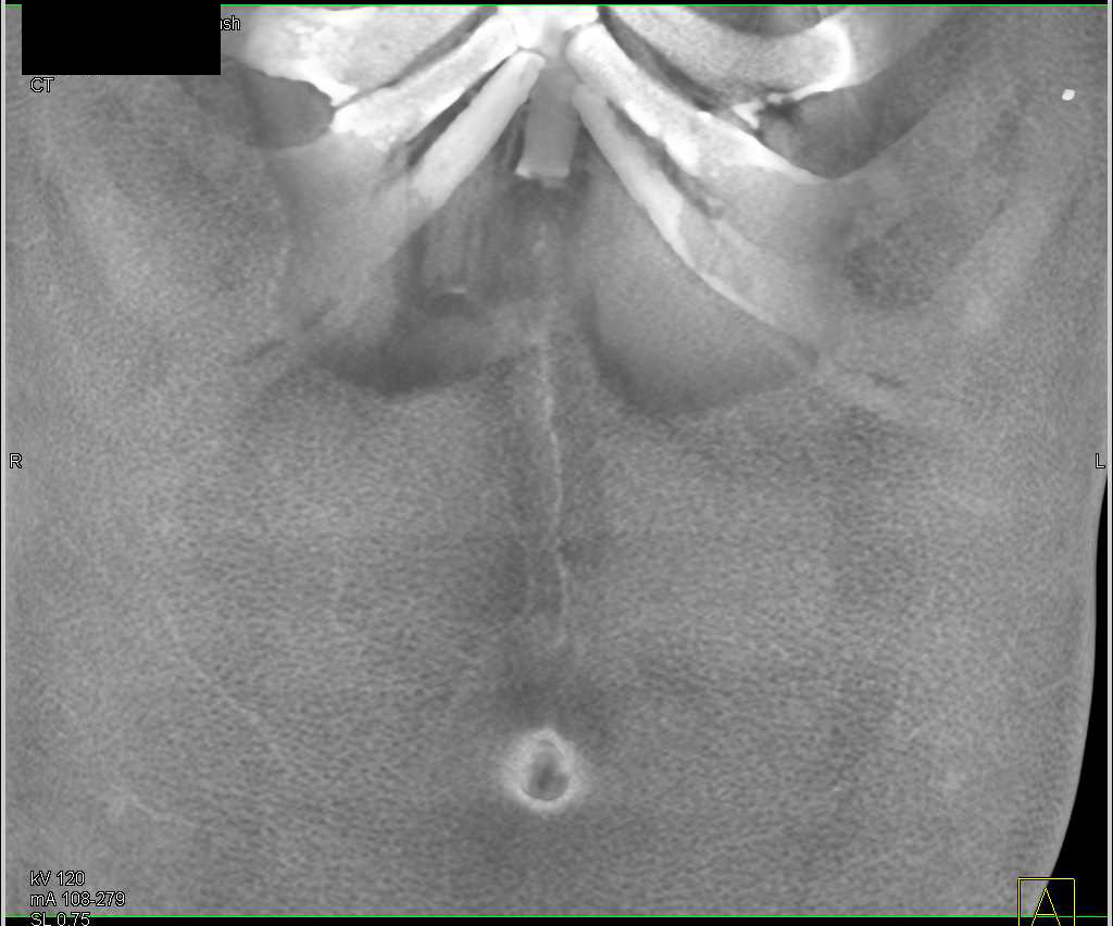 Colitis Transverse Colon - CTisus CT Scan