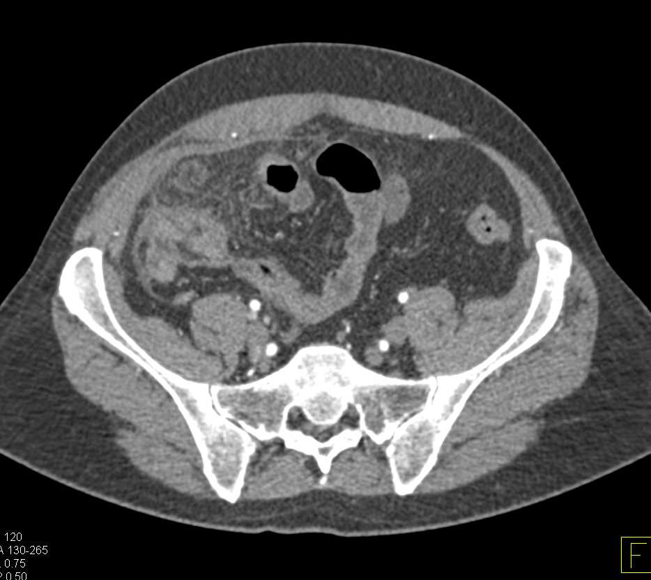 Crohn's Disease in Right Lower Quadrant - CTisus CT Scan