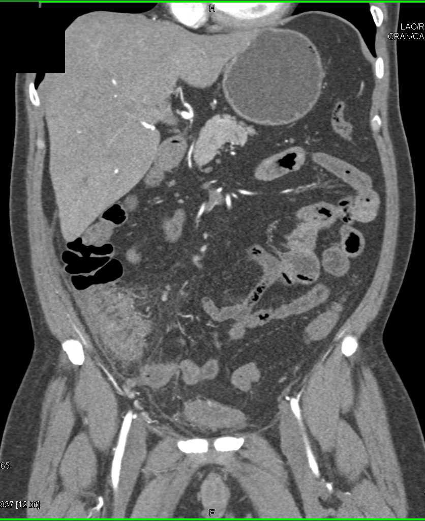 Crohn's Disease in Right Lower Quadrant with Active Inflammation - CTisus CT Scan