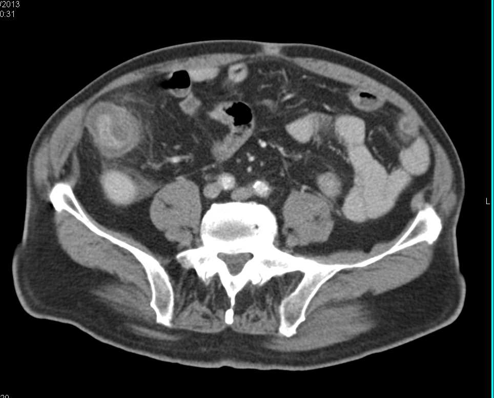 Pseudomembranous Colitis with Minimal Ascites - CTisus CT Scan