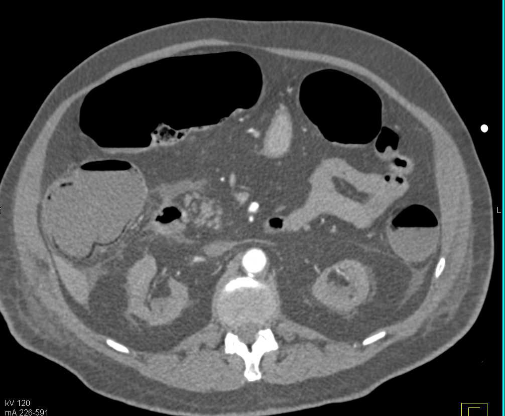Pneumatosis Right Colon with Misty Peri-colonic Fat due to Early Ischemia - CTisus CT Scan