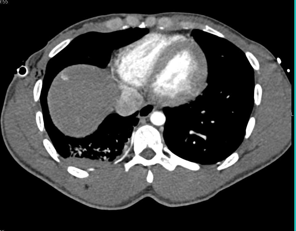 MVA with Pneumothorax and Suspected Colon Injury with Rectal Contrast - CTisus CT Scan
