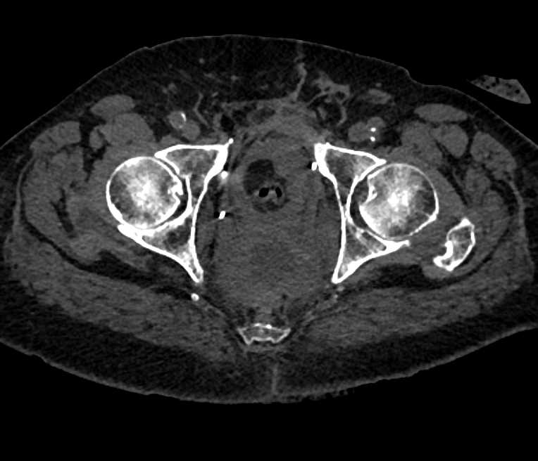 CT Cystogram with Recto-Vesicle Fistulae - CTisus CT Scan