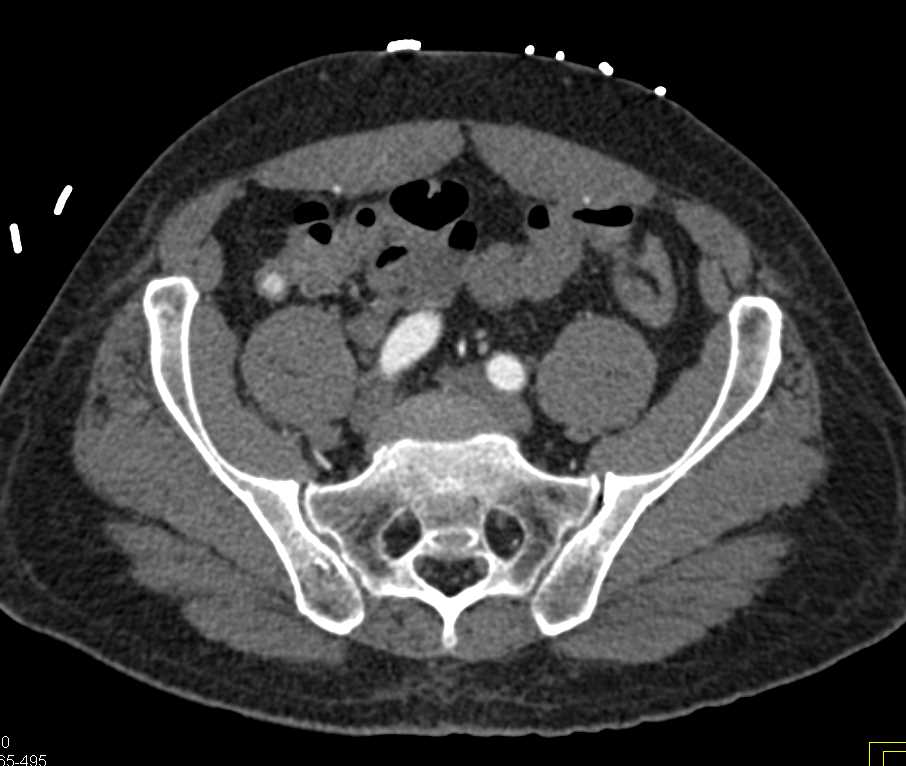 Gastrointestinal (GI) Bleed in Cecum - CTisus CT Scan