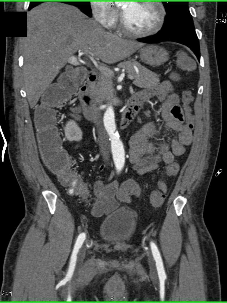 Active Bleed in Cecum on CT Angiography - CTisus CT Scan