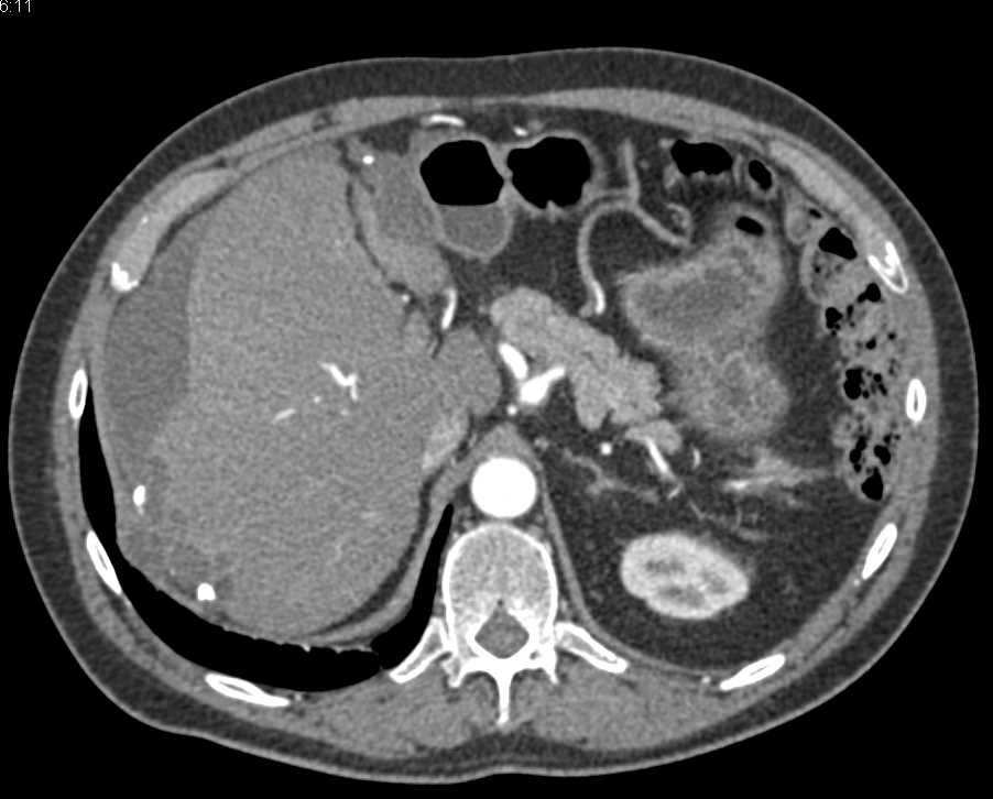 Pseudomyxoma Peritonei (PMP) in Patient With History of Colon Cancer - CTisus CT Scan