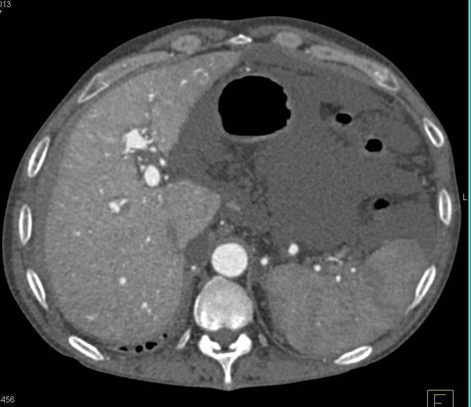 Pseudomembranous Colitis (PMC) in a Renal Transplant Patient - CTisus CT Scan