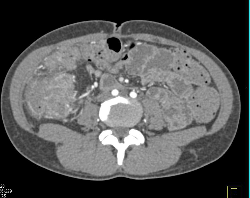 Right Colon Cancer - CTisus CT Scan