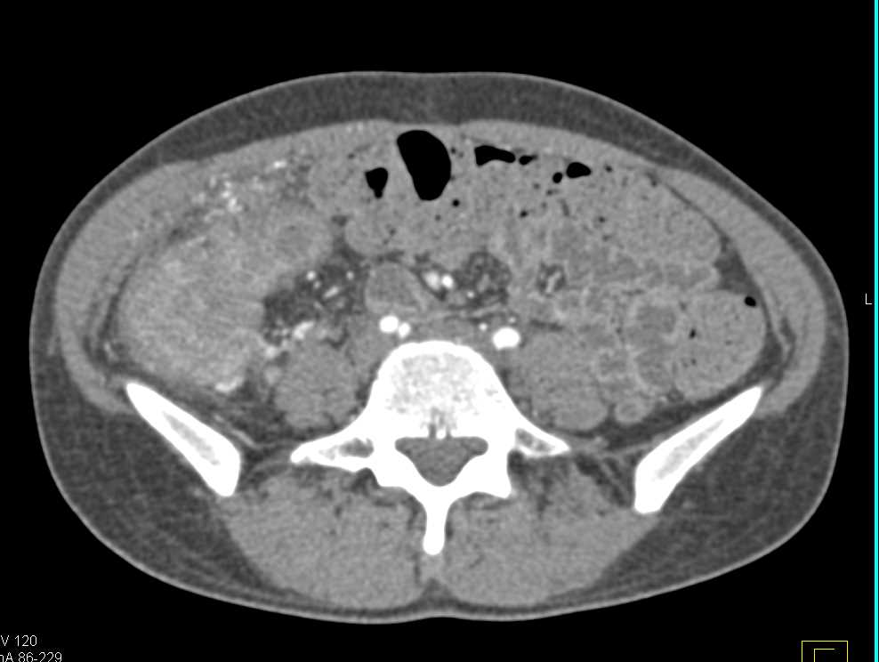 Crohn's Disease Involves the Terminal Ileum and Cecum - CTisus CT Scan