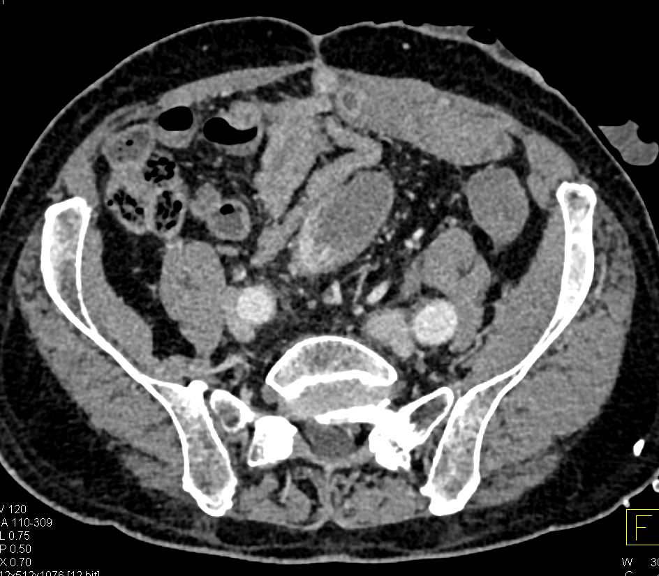 Stent in Rectum with Bulky Invasive Rectal Cancer - CTisus CT Scan