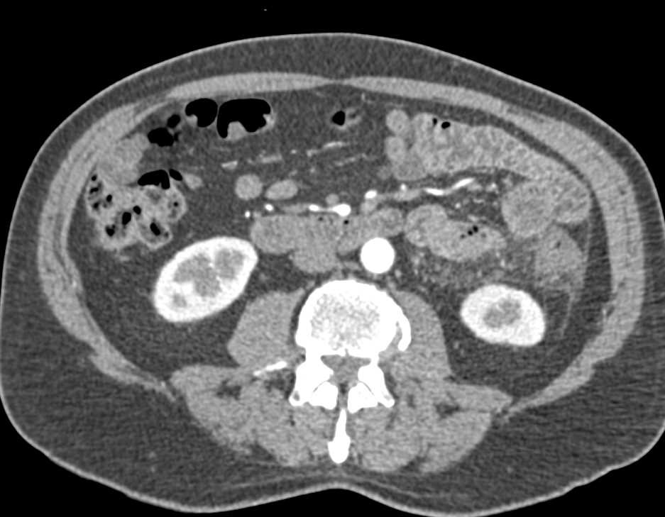 Diverticulitis Descending Colon Inflames Adjacent Jejunal Small Bowel Loops - CTisus CT Scan