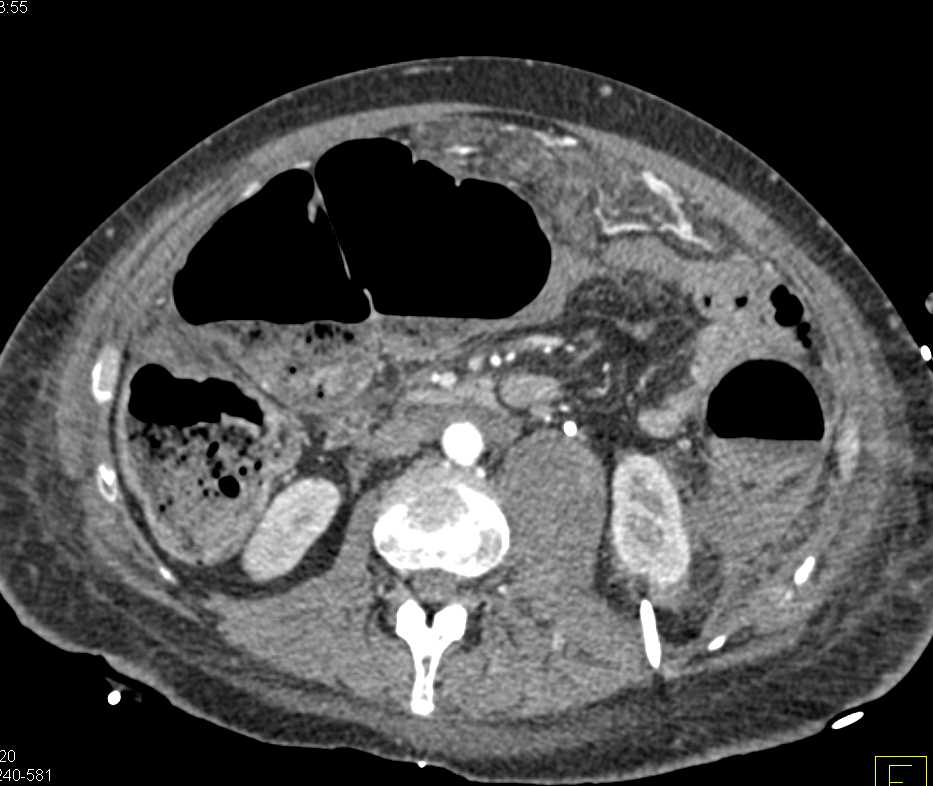 Rectal Carcinoma with Carcinomatosis and Extensive Pelvic Disease - CTisus CT Scan