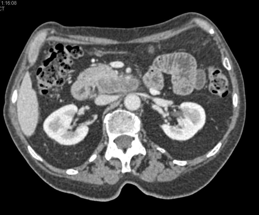 Portocaval Nodes in a Patient with Colon Cancer - CTisus CT Scan