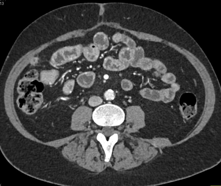 1 cm Implant on Omentum in the Right Lower Quadrant - CTisus CT Scan