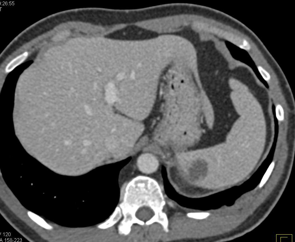 Colitis with Cystic Mesenteric Nodes due to Mycobacterium avium/intracellulare (MAI) Infection - CTisus CT Scan