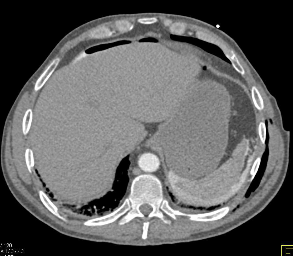 Perforated Left Colon with Pneumoperitoneum - CTisus CT Scan