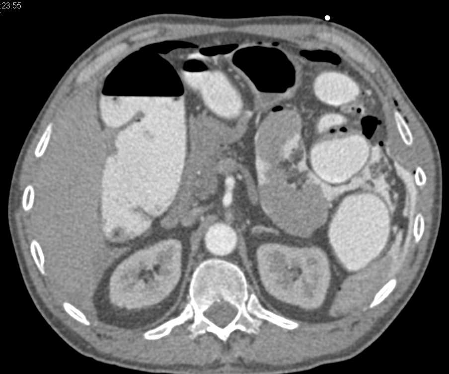 Perforated Left Colon with Pneumoperitoneum Following CT Enema - CTisus CT Scan