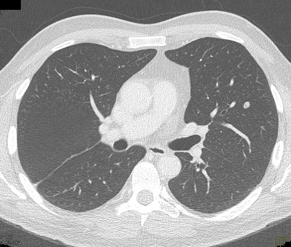 Colon Cancer with Lung and Liver Metastases - CTisus CT Scan