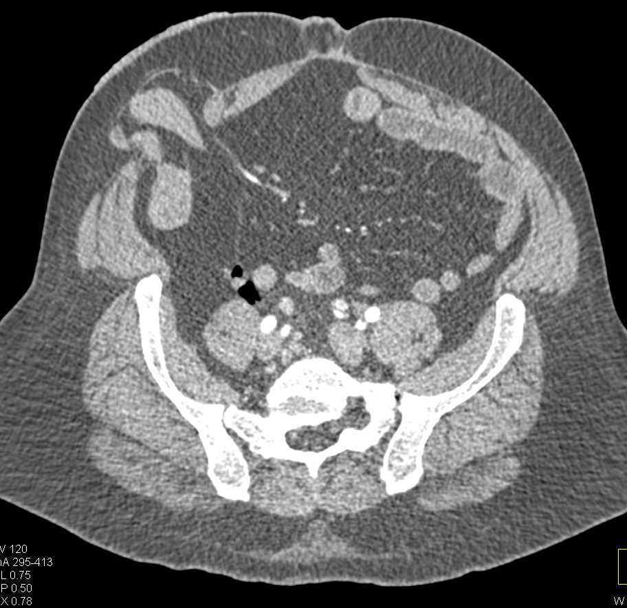 Free Retroperitoneal Air due to Perforated Rectum - CTisus CT Scan