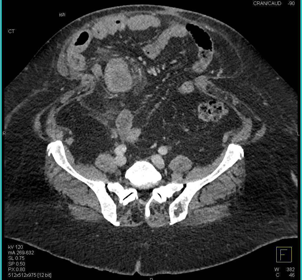 Perforated Colon Cancer - CTisus CT Scan