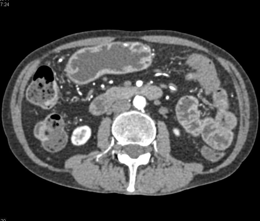 Colitis with Gastrointestinal (GI) Bleed from Inflamed Rectum - CTisus CT Scan