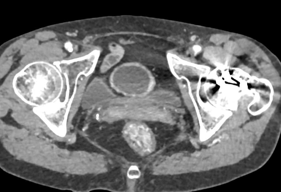 Ulcerative Colitis Especially Well Seen in Transverse Colon - CTisus CT Scan