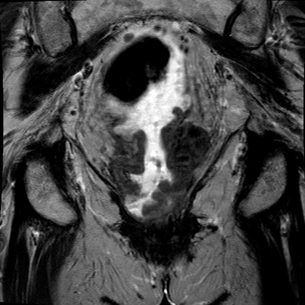 Rectal Cancer - CTisus CT Scan