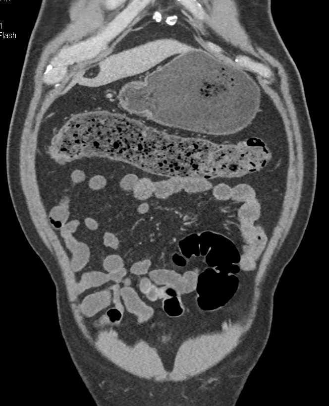 Ulcerative Colitis Best Seen in the Right Colon and Transverse Colon - CTisus CT Scan