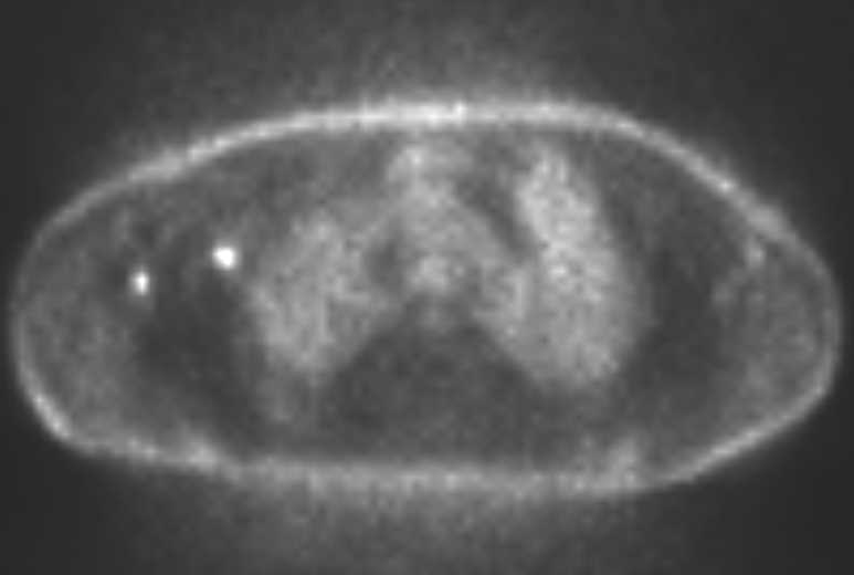 Rectal Cancer with Lung Metastases - CTisus CT Scan