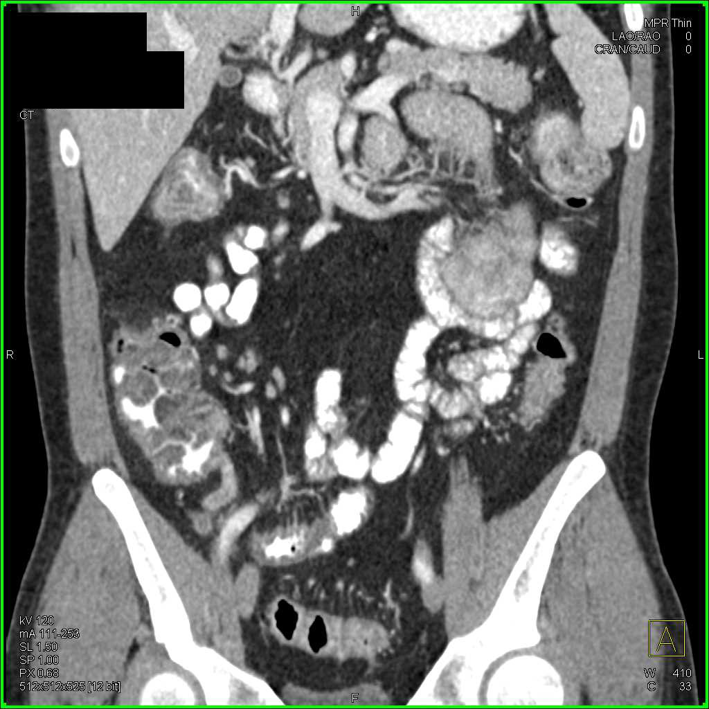 Ulcerative Colitis Best Seen in the Right Colon in 3D - CTisus CT Scan