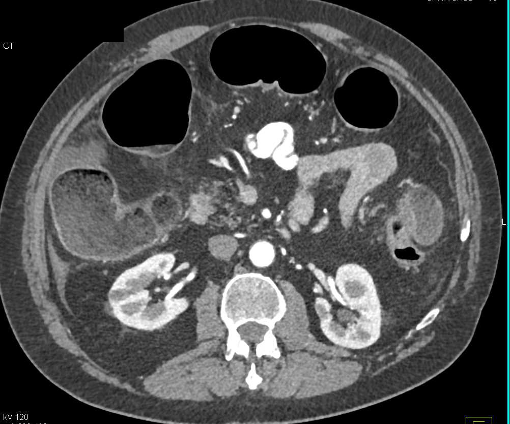 multifocal-colon-cancer-colon-case-studies-ctisus-ct-scanning