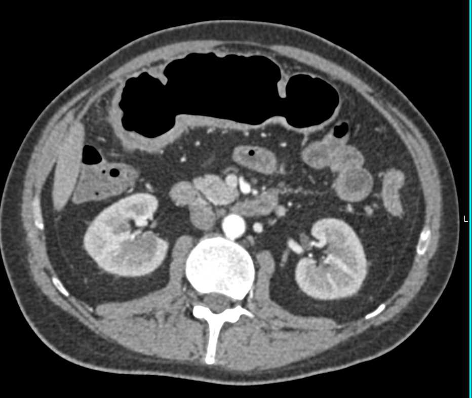 Colitis Colon due to Inflammatory Bowel Disease - CTisus CT Scan