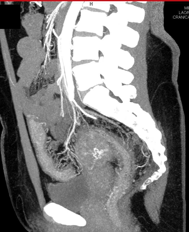 Acute Colitis Left Colon and Sigmoid Colon and Rectum with Prominent Vessels and Gastrointestinal (GI) Bleed - CTisus CT Scan