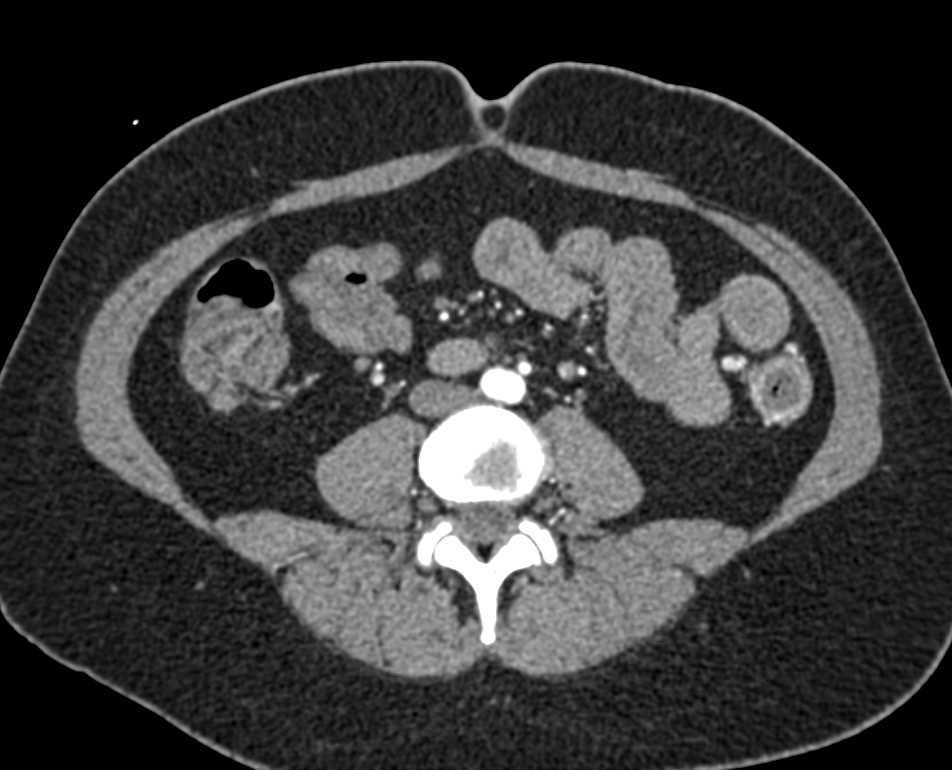 Acute Colitis Left Colon and Sigmoid Colon and Rectum with Prominent Vessels and Gastrointestinal (GI) Bleed - CTisus CT Scan