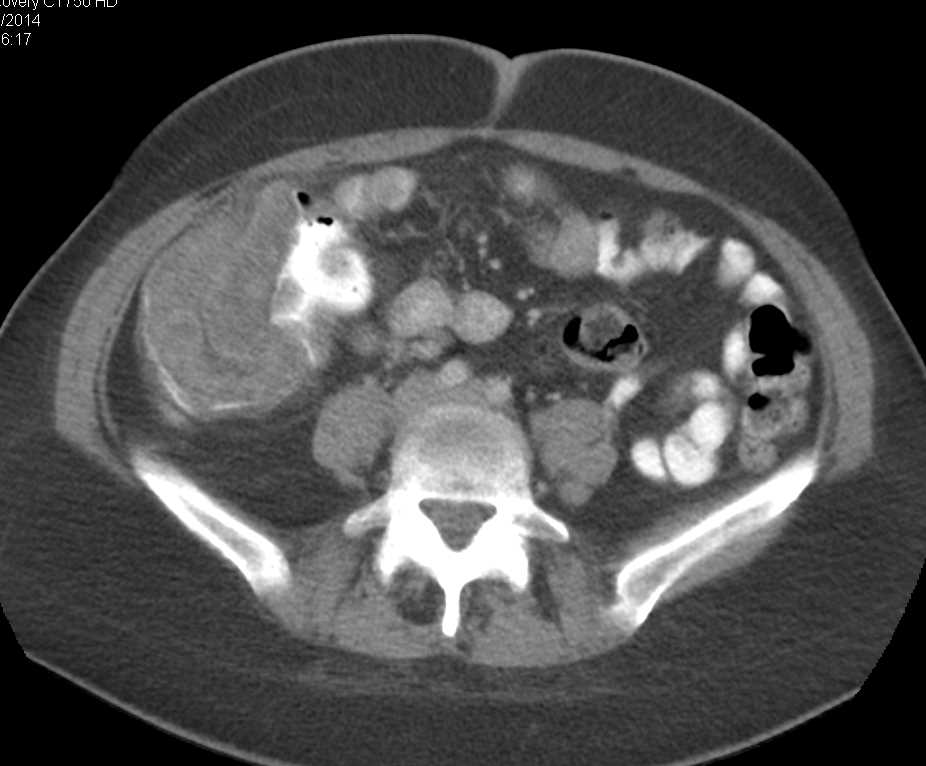 Carcinoma Cecum and Ascending Colon - CTisus CT Scan
