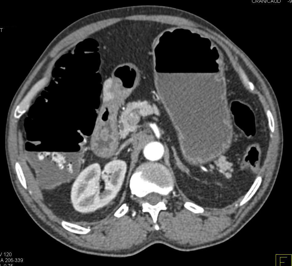 Colon Obstruction at Splenic Flexure due to Carcinoma - CTisus CT Scan
