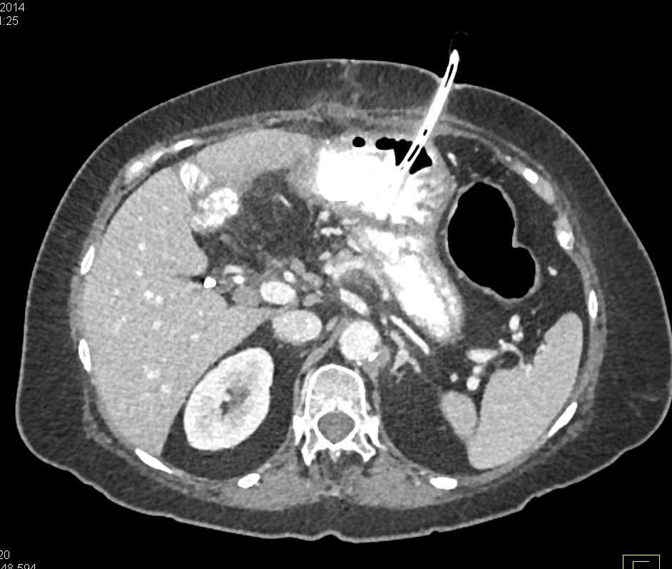 Pneumatosis Right Colon Following G-Tube Placement - CTisus CT Scan